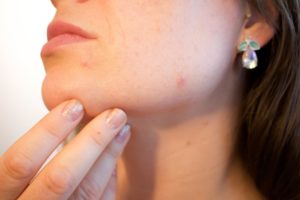 Zinksalbe gegen Pickel – Hausmittel für reine Haut